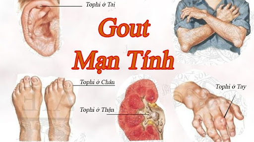 Những biến chứng nguy hiểm đến từ căn bệnh Gout